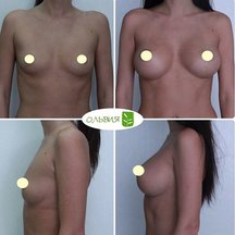 Подтяжка груди, абдоминопластика, спустя 8 месяцев