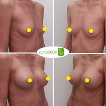 Подтяжка груди с установкой имплантов, спустя 6 месяцев