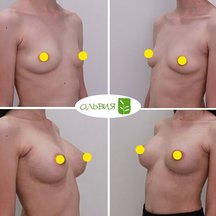 Подтяжка груди с установкой имплантов, спустя 6 месяцев 