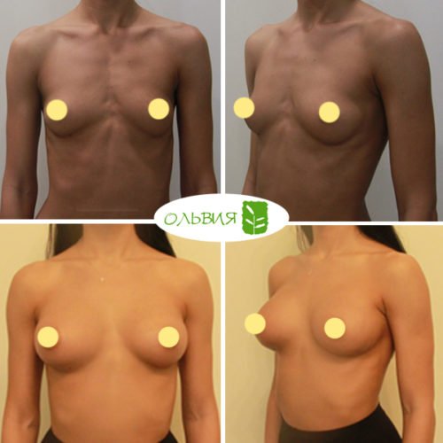 Эндоскопическое увеличение груди, Nador анатомия 375гр, спустя 3 недели 