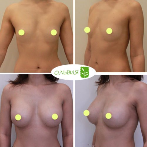 Эндоскопическое увеличение груди, Nagor 335гр, спустя 2 месяца 