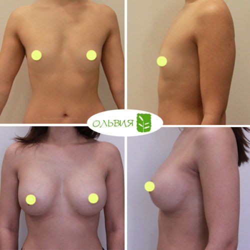 Эндоскопическое увеличение груди, Nagor 335гр, спустя 2 месяца 