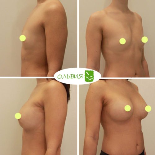 Эндоскопическое увеличение груди, Nagor 335гр, спустя 3 недели 