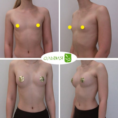 Эндоскопическое увеличение груди, импланты SEBBIN 280гр, спустя 1 месяц 