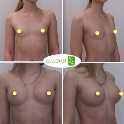 Эндоскопическое увеличение груди, импланты SEBBIN 280гр, спустя 3 месяца 