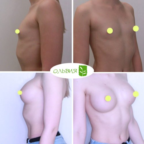 Эндоскопическое увеличение груди, импланты SEBBIN 280гр, спустя 4 месяца 