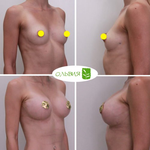 Увеличение груди, Nagor 375гр, спустя 2 недели
