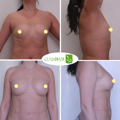 Липофилинг груди, фото спустя 1 месяц 