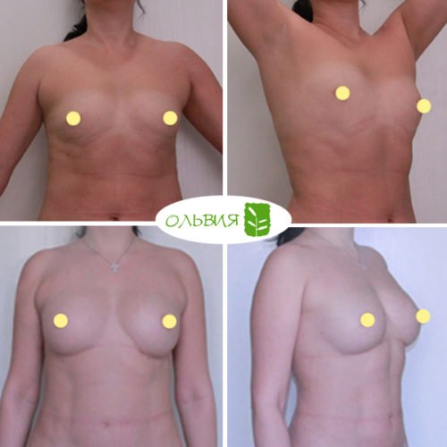 Липофилинг груди, фото спустя 1 месяц