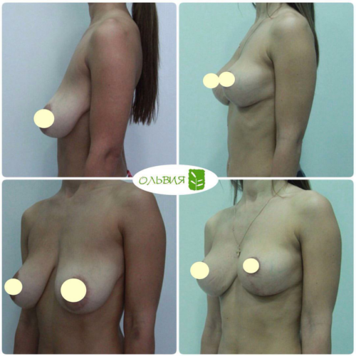 Подтяжка и липофилинг груди, фото спустя 3 месяца 