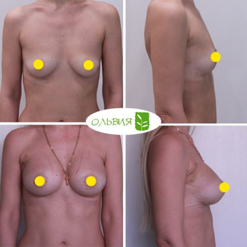 Увеличение груди имплантами Sebbin 325гр, спустя 2 недели
