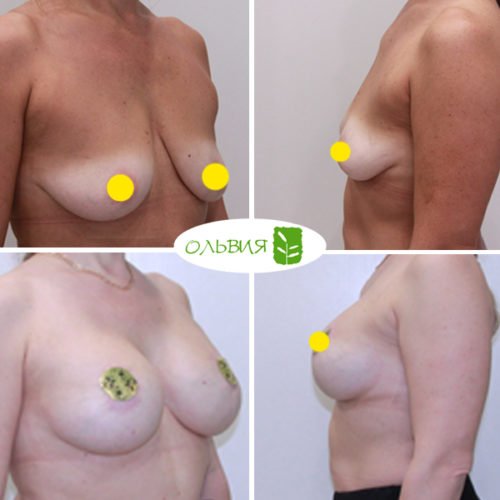 Подтяжка груди с имплантами, спустя 5 месяцев