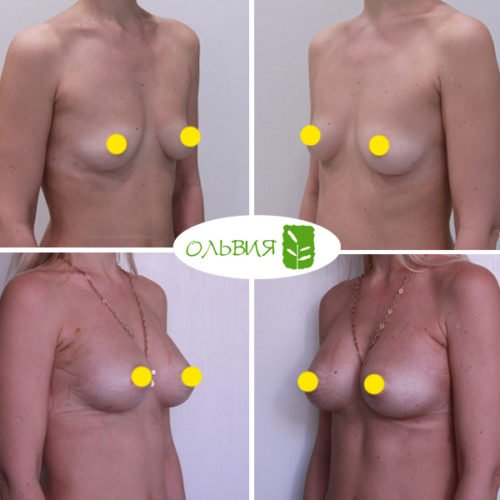 Увеличение груди имплантами Sebbin 325гр, спустя 2 недели