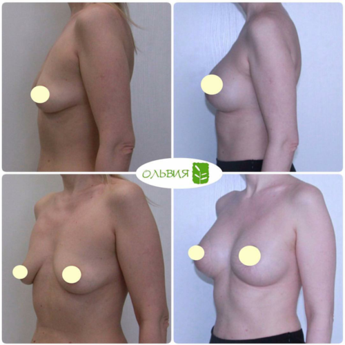 Периареолярная подтяжка груди с установкой имплантов 280гр и 325гр, спустя 1 месяц