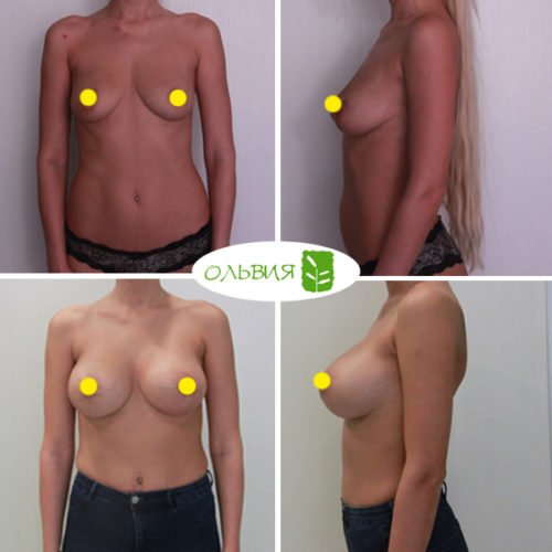 Периареолярная подтяжка груди с установкой имплантов NAGOR 440гр, фото спустя 2 недели