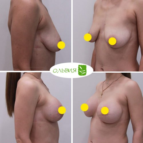 Подтяжка груди с имплантами, Sebbin 325гр, спустя 3 месяца