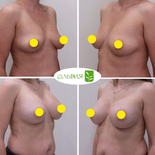 Подтяжка груди с имплантами, Sebbin 325гр, спустя 6 месяцев