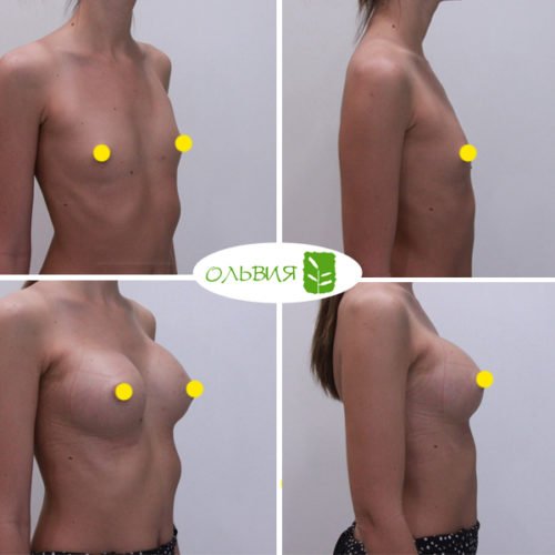 Увеличение груди, Nagor 335гр, спустя 2 недели 