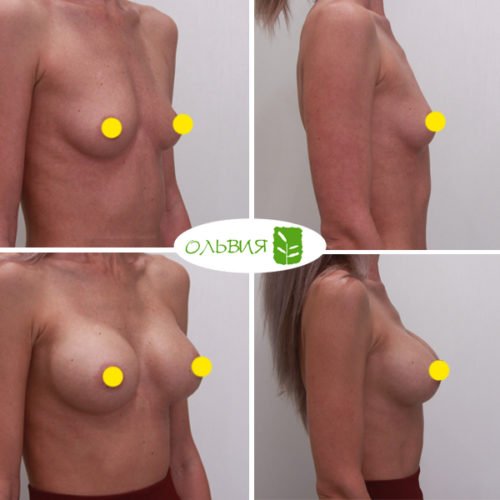 Увеличение груди, Sebbin 325гр, спустя 1 месяц
