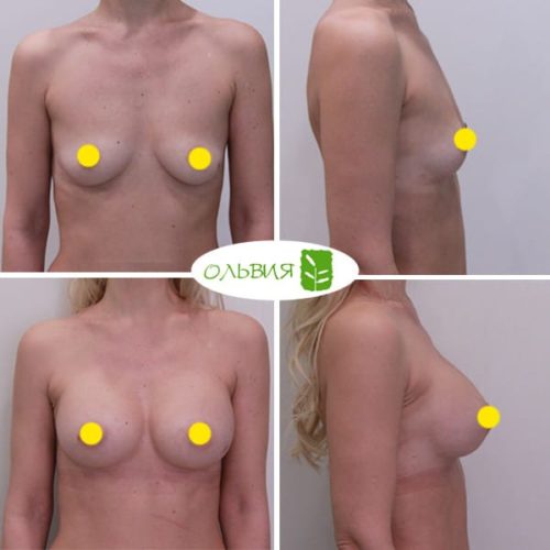 Увеличение груди Sebbin 325гр, спустя 3 месяца