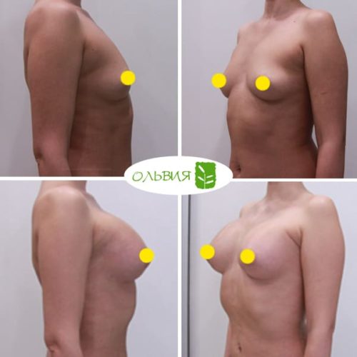 Увеличение груди Sebbin 370гр, спустя 3 месяца