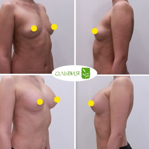 Увеличение груди Sebbin 370гр, спустя 3 месяца