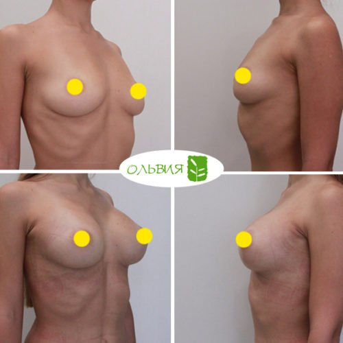 Увеличение груди имплантами, Sebbin 325гр, спустя 1 месяц 