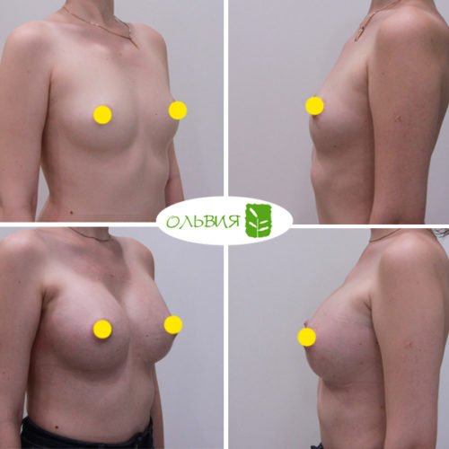 Увеличение груди имплантами Sebbin 325гр, спустя 1 месяц
