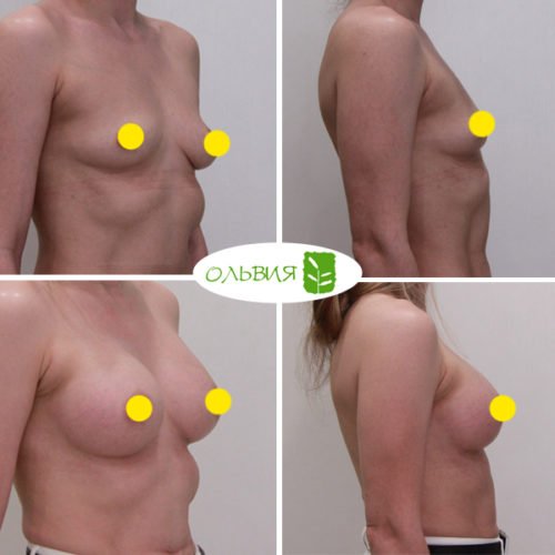 Увеличение груди имплантами Sebbin 325гр, спустя 3 месяца