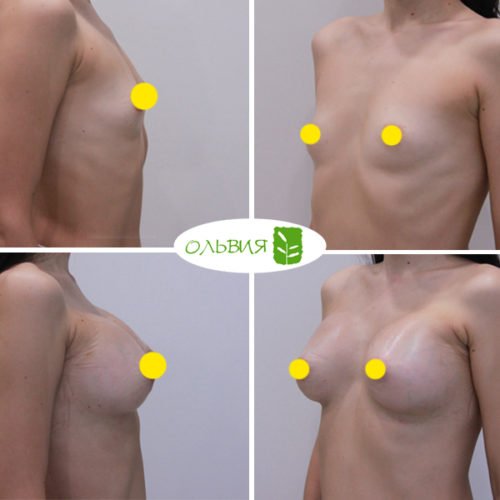 Увеличение груди имплантами (подмышечный доступ), спустя 2 недели