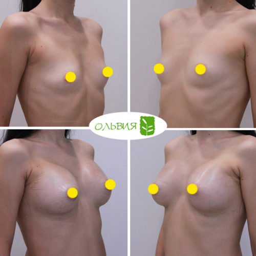 Увеличение груди имплантами (подмышечный доступ), спустя 2 недели