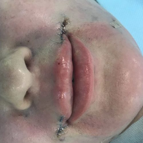 Корнер-лифт, липофилинг губ сразу после операции