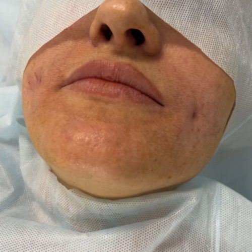 Димпл-эктомия (ямочки на щечках), сразу после операции