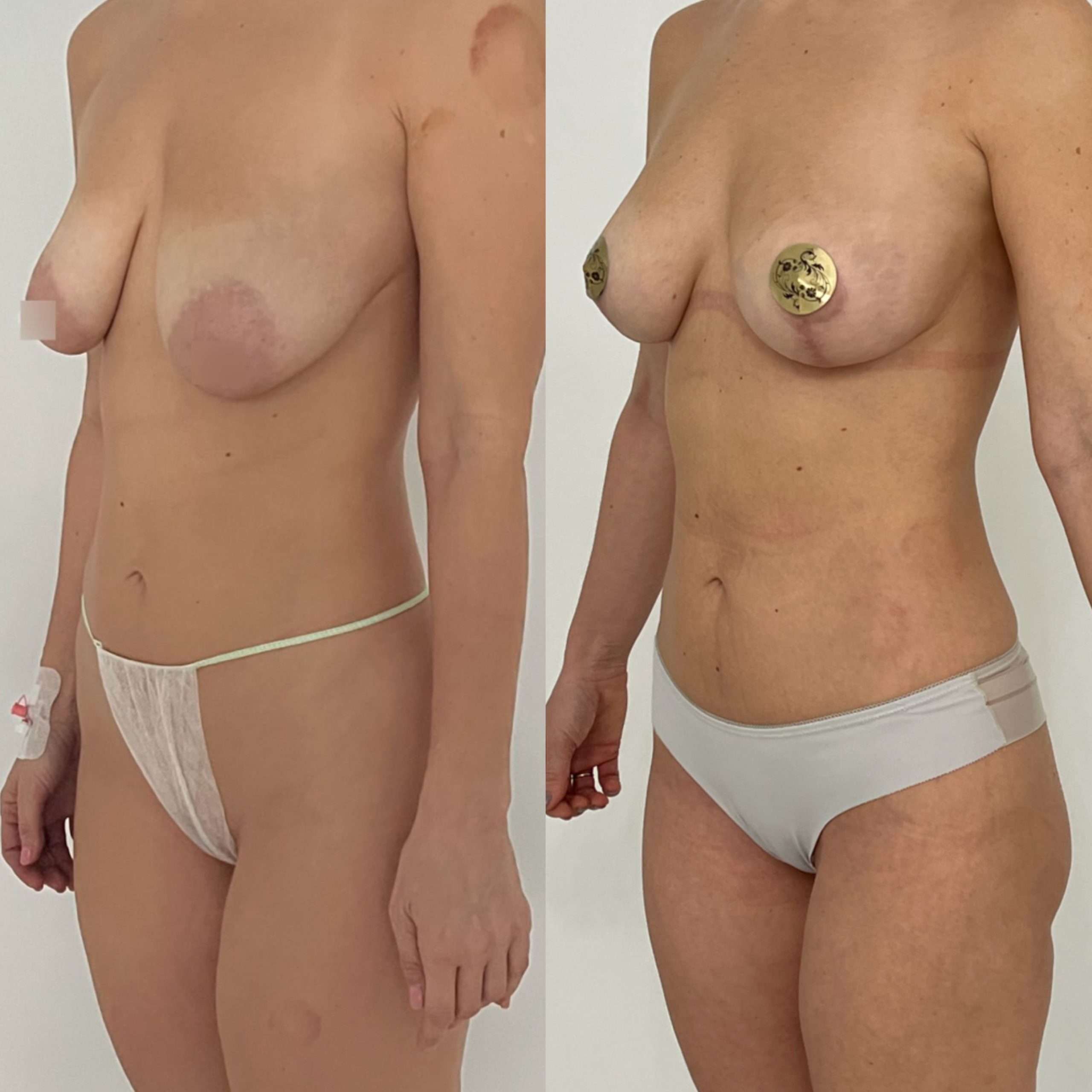 липосакции груди у женщин фото 3