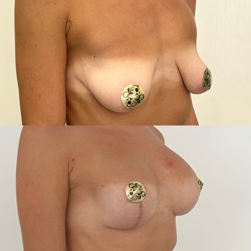 Подтяжка груди с имплантами 275гр, спустя 3 месяца