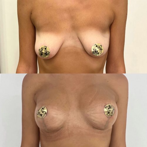 Подтяжка груди с имплантами 275гр, спустя 3 недели