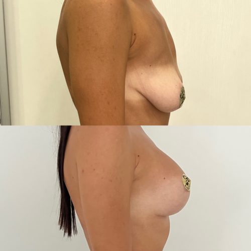 Подтяжка груди с имплантами 275гр, спустя 6 месяцев