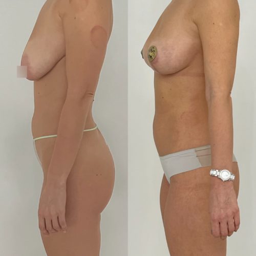 Редукция груди, липосакция плеч, задней пов. бёдер, липофилинг груди, спустя 3 месяца