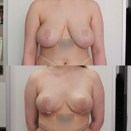 Редукция груди, спустя 1,5 месяца