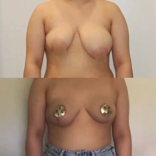 Редукция груди, спустя 6 месяцев