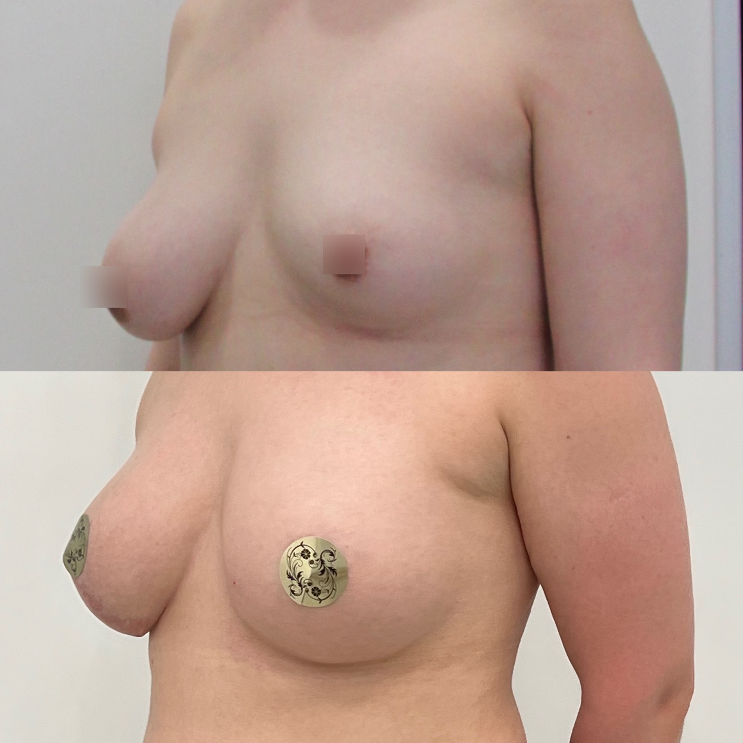 как проходит операция по уменьшению груди у женщин фото 45