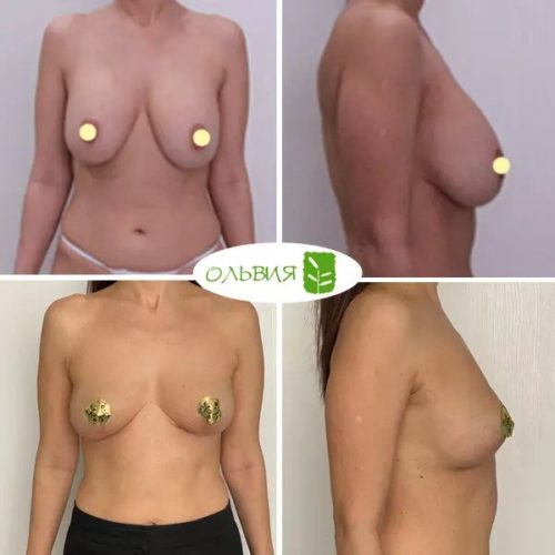 Удаление имплантов с подтяжкой груди, спустя 1 месяц