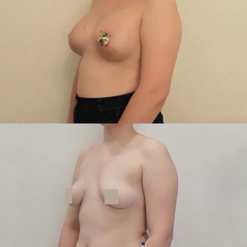 Подтяжка груди с имплантами, 330гр, спустя 2 недели