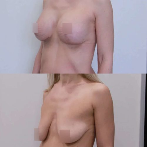 Подтяжка груди с имплантами 335гр, спустя 2 месяца