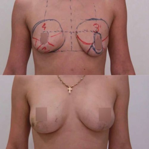 Подтяжка груди с липофилингом, спустя 3 недели