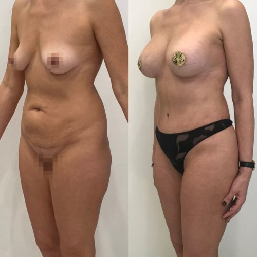 Абдоминопластика, липосакция галифе, поясницы, увеличение груди имплантами 325гр, спустя 3 месяца 