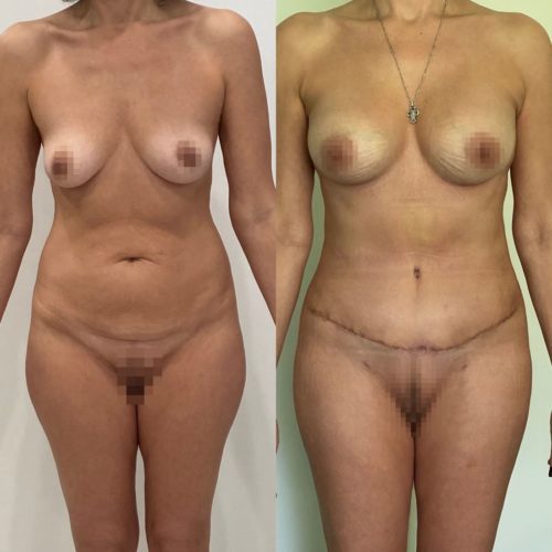 Абдоминопластика, липосакция галифе, поясницы, увеличение груди имплантами 325гр, спустя 3 месяца
