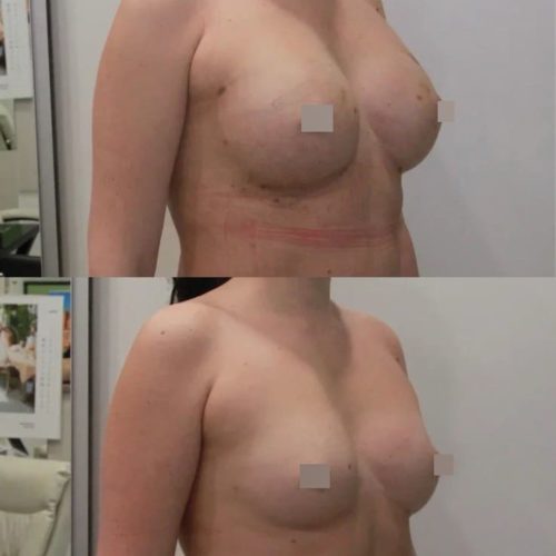 Липофилинг груди, спустя 2 недели