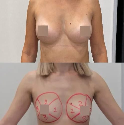 Липофилинг груди, спустя 3 месяца