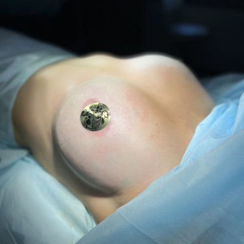 Липофилинг груди сразу после операции